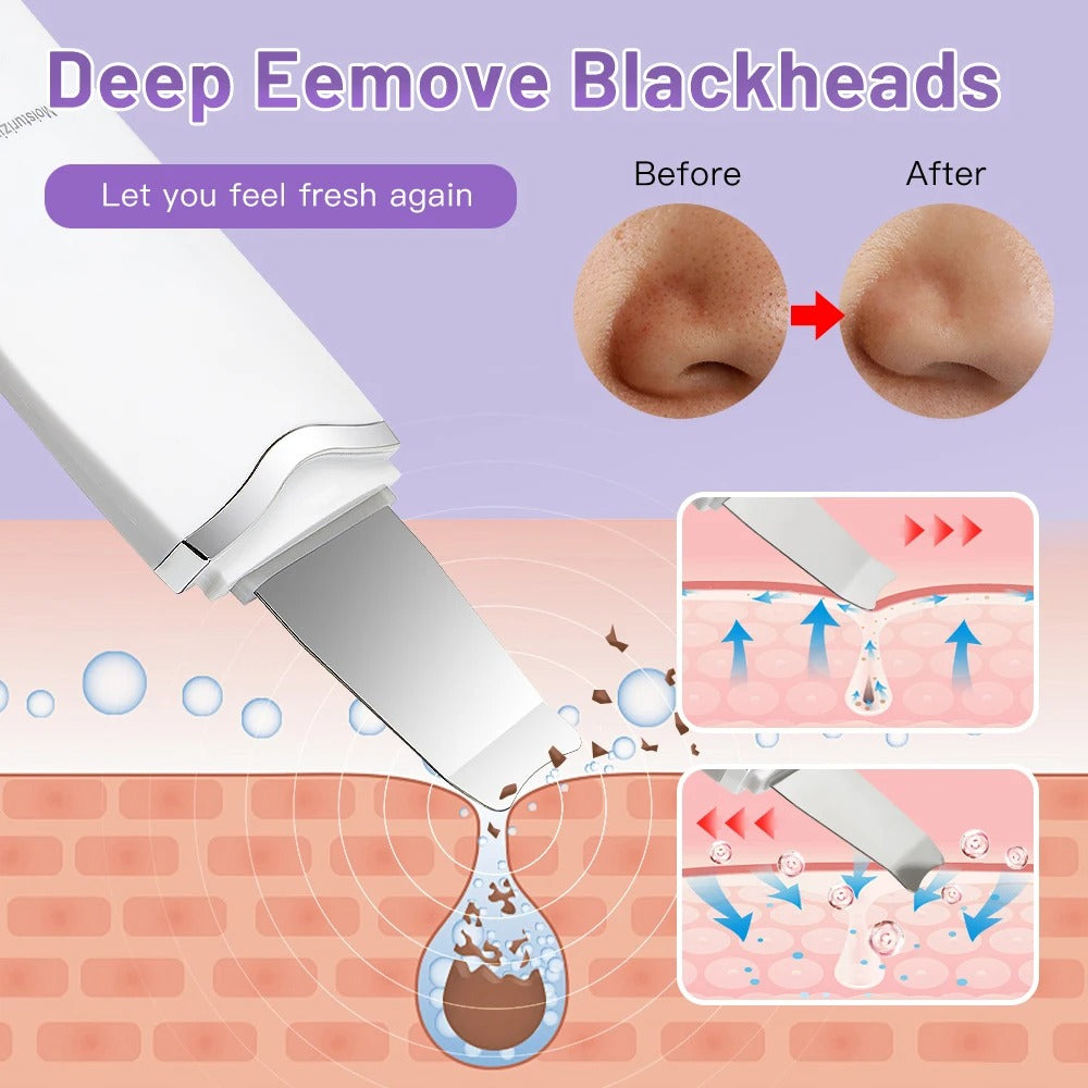 Espátula Facial Ultrasónica Exfoliante